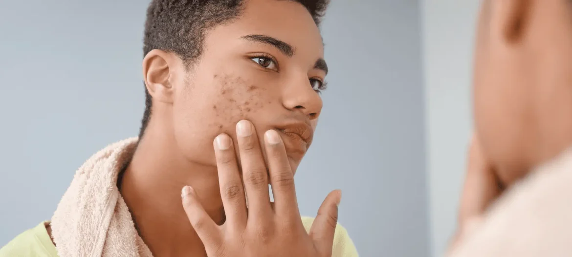 The Gut-Skin Connection: How Your Gut Health Directly Impacts Acne
